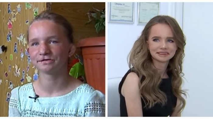 Изувеченной родными алматинке подарили новое лицо Изувеченной родными алматинке подарили новое лицо