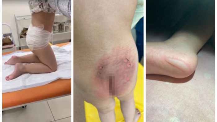 Няню уволили из детсада в Актау после термического ожога у ребенка Няню уволили из детсада в Актау после термического ожога у ребенка