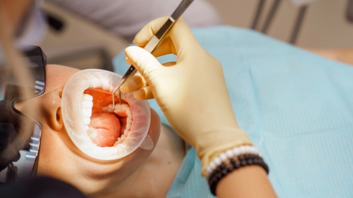 Можно ли удалять детям зубы мудрости в рамках ОСМС, рассказали в Фонде социального медстрахования
Можно ли удалять детям зубы мудрости в рамках ОСМС, рассказали в Фонде социального медстрахования